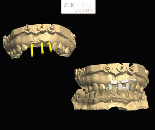 Digitale Implantatplanung - Oberkiefer mit Implantatpositionen und Gesamtkieferansicht
