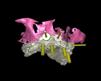 3D-navigierte Implantologie