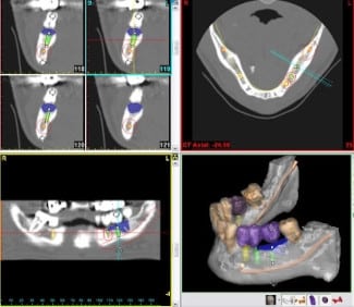 Minimalinvasive Implantologie