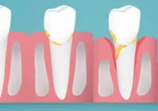 Zahnfleischentzündung (Gingivitis)