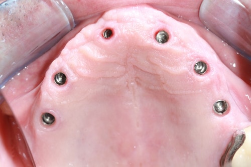 all on six implantate ohne versorgung