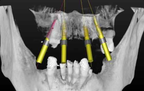 Patientenfall All-on-4 - Implantatplanung