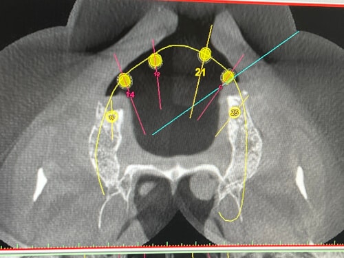 Patientenfall: All-on-6 - Implantatplanung
