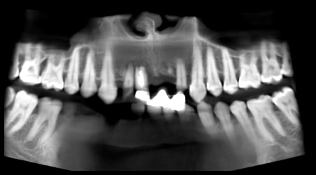 Patientenfall Implantatbrücke - Röntgenaufnahmen