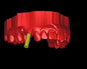 Patientenfall Einzelimplantat - 3D-Planung