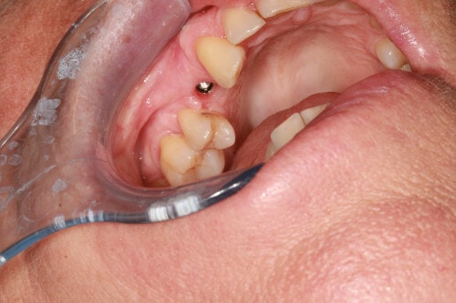 Patientenfall Einzelimplantat - Implantat