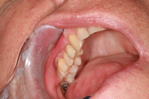 Patientenfall Einzelimplantat - Anprobe