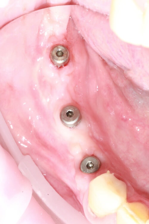 Patientenfall Freinendsituation - Implantate