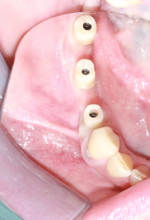 Patientenfall Freinendsituation - Implantataufbau