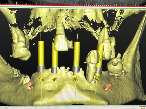 Patientenfall: Locatoren - Implantatplanung