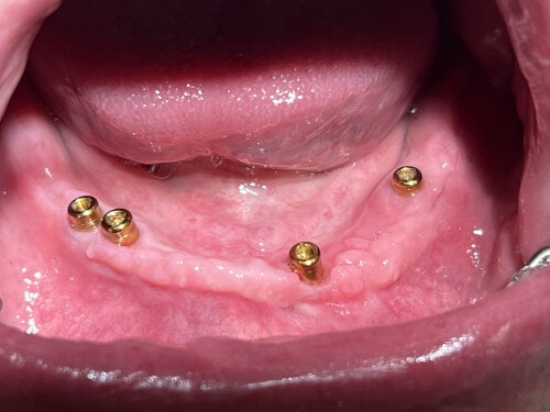 Patientenfall: Locatoren - Implantate