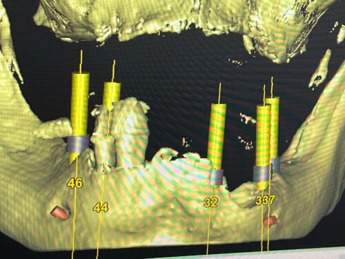 Patientenfall: Stegkonstruktion - Implantatplanung