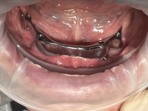 Patientenfall: Stegkonstruktion - Implantate