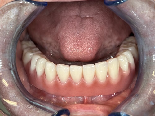 Patientenfall: Stegkonstruktion - Anprobe