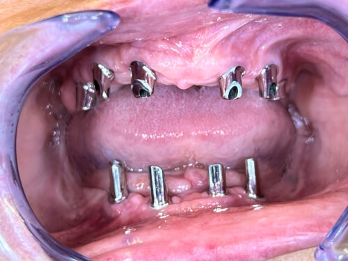 Patientenfall: Teleskope - Implantate