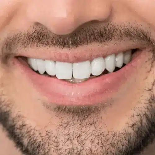 Hollywood Smile - Mann