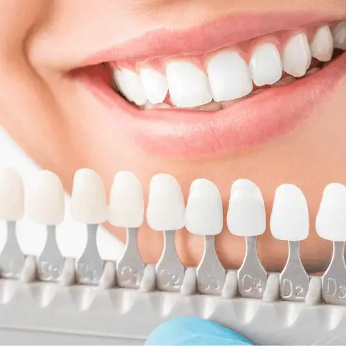 Lächeln mit Farbskala zum Abgleich der Zahnfarbe