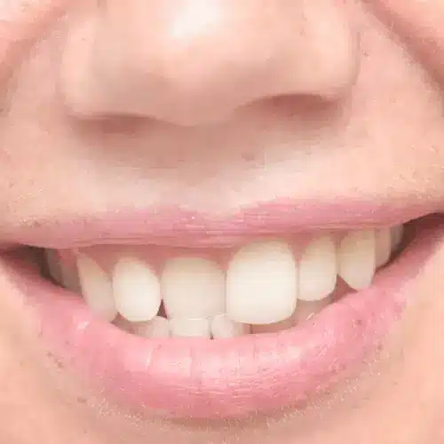 Zahnfehlstellung der Schneidezähne