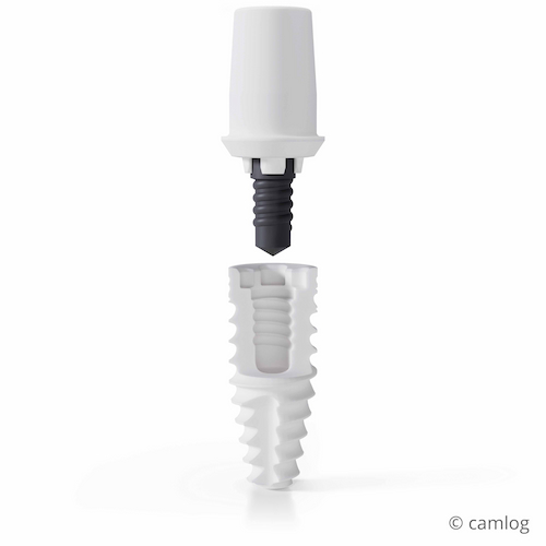 Ceralog Progressive Line Keramikimplatat: Implantat-Abutment-Verbindung