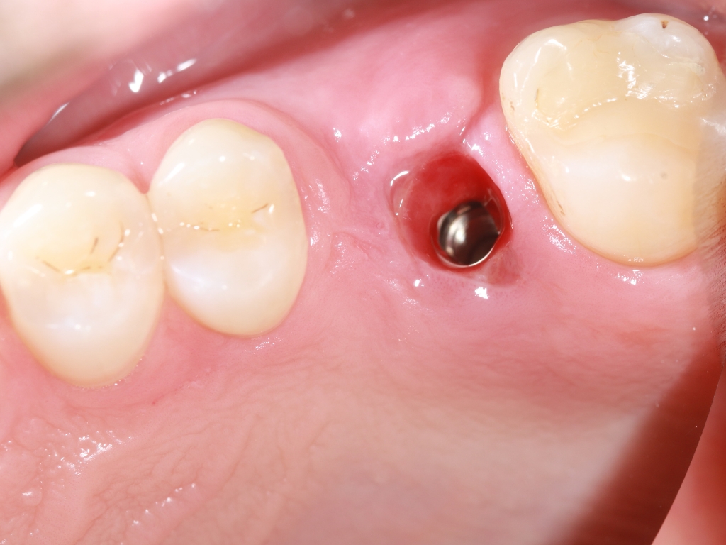 Zahnreihe mit abgeheilter Implantatschraube