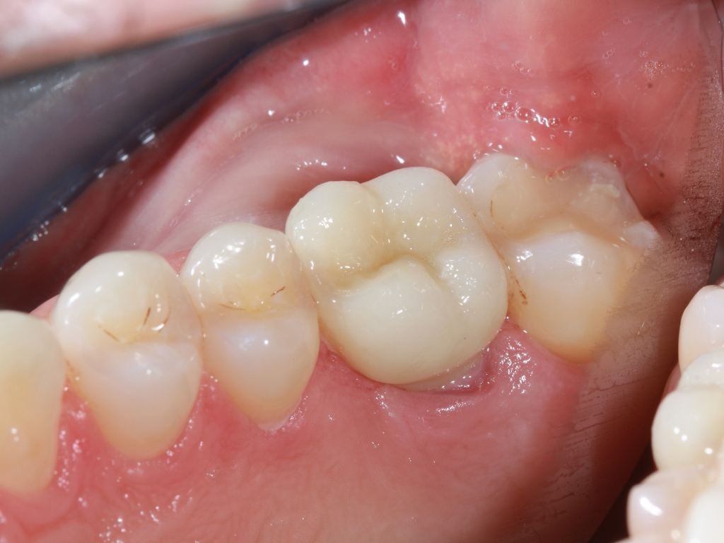 Zahnkrone auf Implantat (Zahn 16)