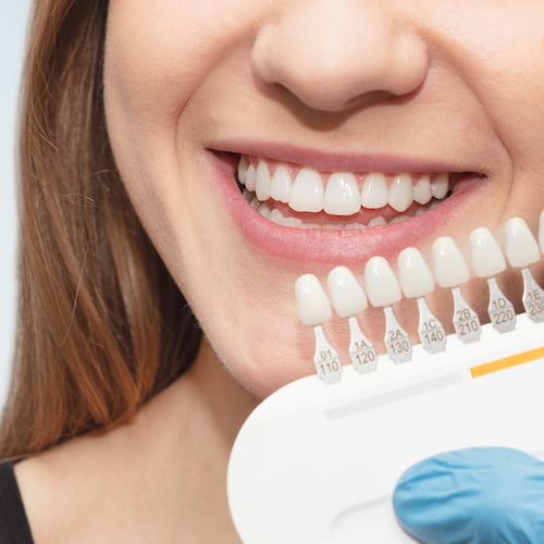 Abgleich der Zahnfarbe mittels Zahnfarbentabelle