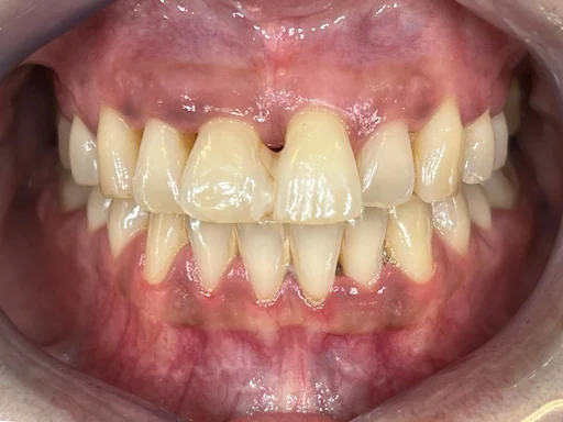 Behandlungsbeispiel - Zähne 11,12,22,21 - Prä-OP