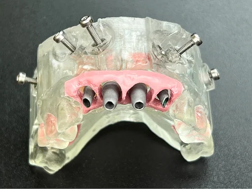 Behandlungsbeispiel - Zähne 11,12,22,21 - Provisorium ohne Zahnersatz