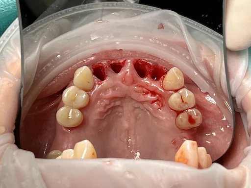 Behandlungsbeispiel - Zähne 11,12,22,21 - Post Extraktion (Ansicht des Oberkiefers)