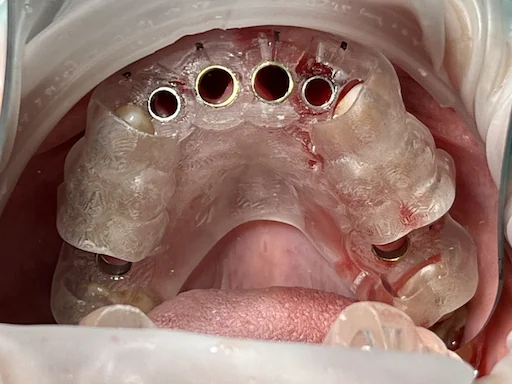 Behandlungsbeispiel - Zähne 11,12,22,21 - Eingesetzte OP-Schablone