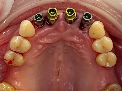 Behandlungsbeispiel - Zähne 11,12,22,21 - Post-Implantation (Ansicht Oberkiefer)