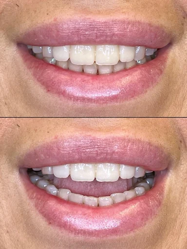 Behandlungsbeispiel - Zähne 11,12,22,21 - Ansicht der Zahnsituation nach der Behandlung