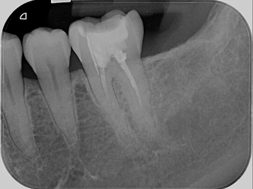 Patientenfall 36, 37 - Röntgenaufnahme der Ausgangssituation