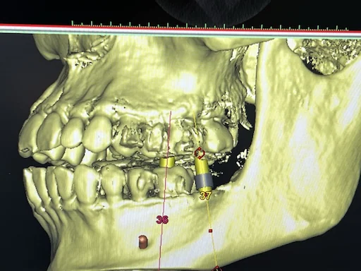 Patientenfall 36, 37 - Implantatplanung