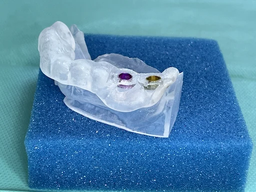 Patientenfall 36, 37 - Bohrschablone für chirurgischen Eingriff