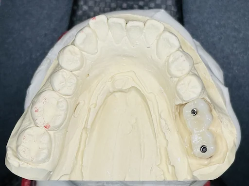 Patientenfall 36, 37 - Zahnersatz