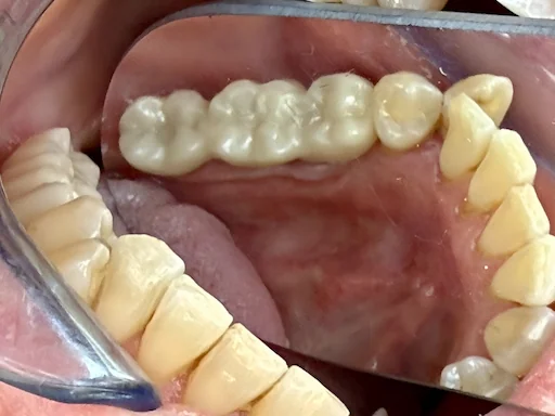 Patientenfall Implantologie - Zähne 45, 46, 47 - Finale Implantatbrücke