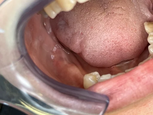 Patientenfall Implantologie - Zähne 45, 46, 47 - Fehlende Zähne in Frontansicht