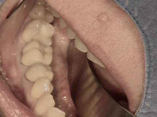 Patientenfall - Implantologie - Zahn 46 - 1