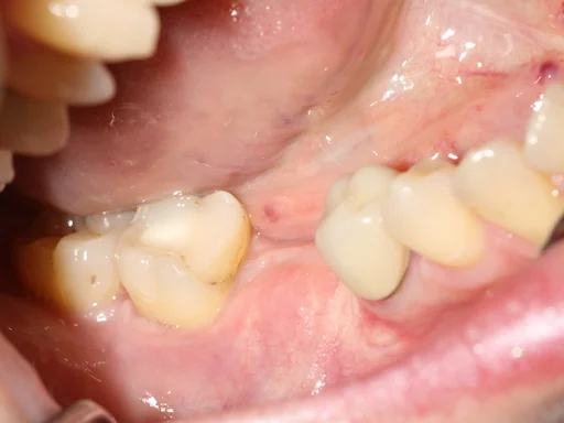 Patientenfall - Implantologie - Zahn 46 - 2