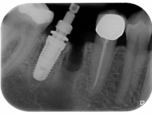 Patientenfall - Implantologie - Zahn 46 - 3