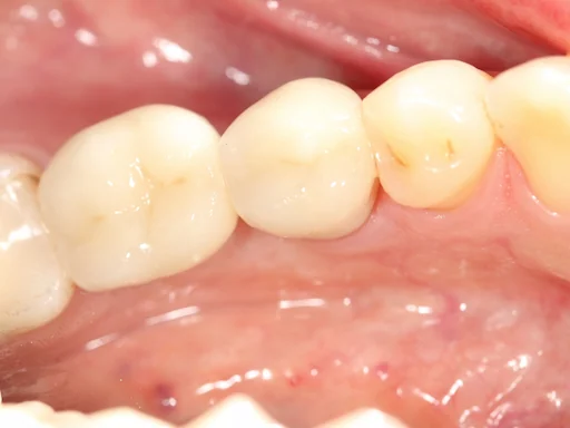 Patientenfall - Implantologie - Zahn 46 - 4