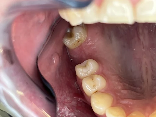 Patientenfall Implantologie: Fehlender Zahn 16 - Ausgangssituation