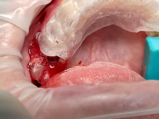 Patientenfall Implantologie: Fehlender Zahn 16 - Bohrschablone im Einsatz