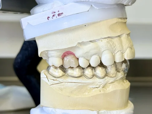 Patientenfall Implantologie: Fehlender Zahn 16 - Prothetische Versorgung