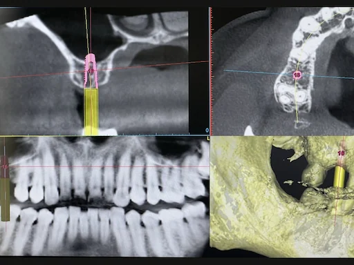 Patientenfall Implantologie: Fehlender Zahn 16 - Implantatplanung