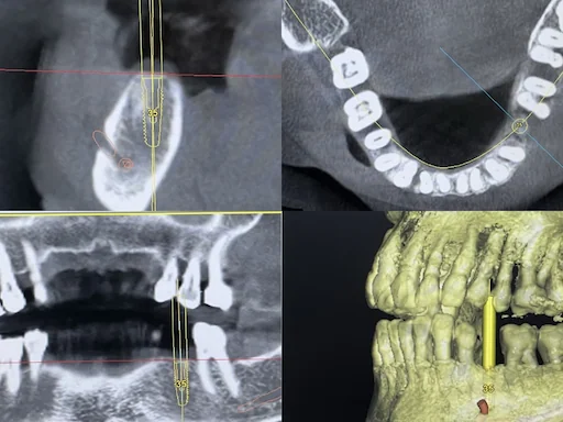 Implantologie Behandlungsbeispiel: Unterkiefer Zahn-36 - Implantatplanung