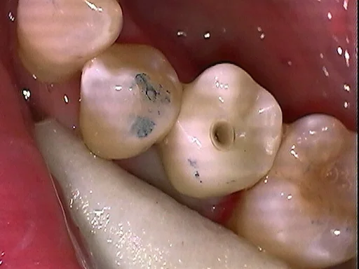 Implantologie Behandlungsbeispiel: Unterkiefer Zahn-36 - Implantatkrone