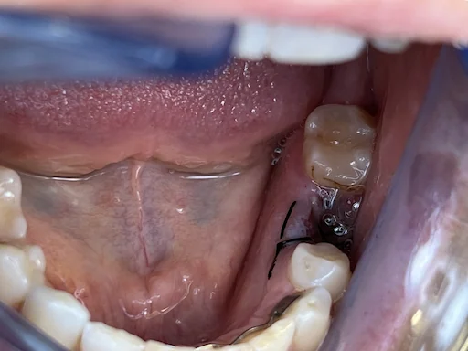 Patientenfall Implantologie: Unterkiefer Zahn 36 - Ausgangssituation