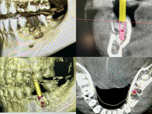 Patientenfall Implantologie: Unterkiefer Zahn 36 - Röntgenaufnahme